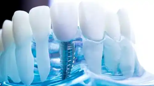 Should I get a dental implant?